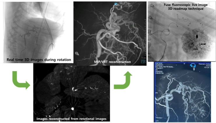 3차원 혈관조영술 과정. 복강 동맥에 장착한 혈관 카테터를 통해서 투시기기에 내장된 cone-beam CT를 이용하여 3차원 영상을 얻어 (가운데 MIP/VRT 영상), 실제 시술 과정에서 실시간으로 투시영상에 결합하여 색전술을 시행할 수 있다.