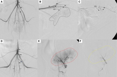 종양으로 공급되는 혈관을 각각 선택하여 색전물질을 주입하였으며 parent artery의 개통을 통해 심각한 합병증이 생기지 않도록 하였다. 논문 중 발췌