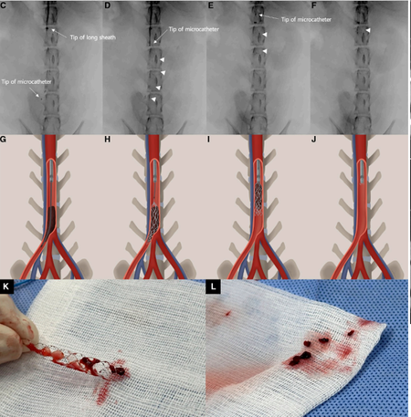 환자의 혈전제거 과정의 모식도 및 제거된 혈전 모습