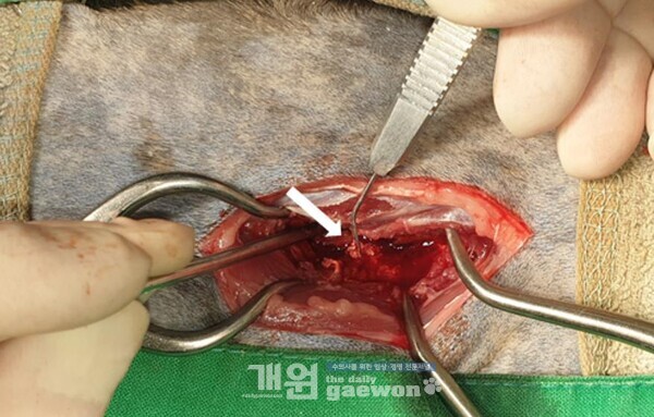 요추 5~6번 후궁 절제술 수술 소견